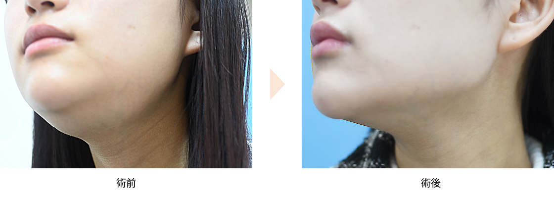 「唾液腺ボトックスによる小顔整形（舌下腺・顎下腺）」の症例写真・ビフォーアフター