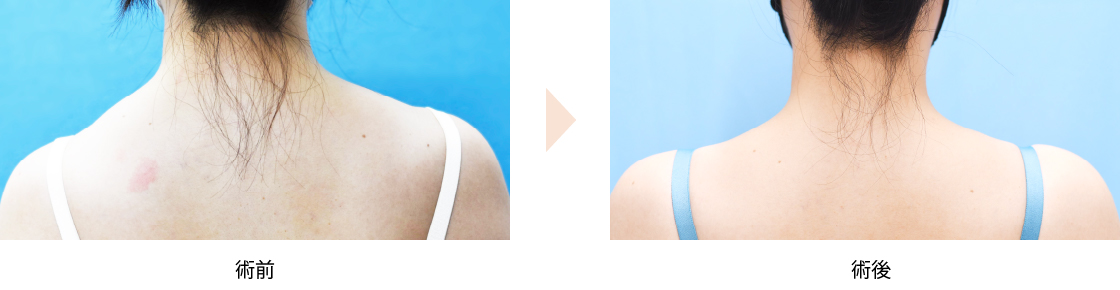 「肩痩せ・肩凝り改善ボトックス注射」の症例写真・ビフォーアフター