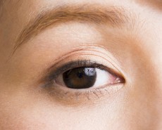 眼瞼下垂・眼瞼挙筋前転法（保険適用）