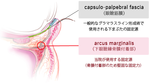 arcus marginalis（下眼瞼縁骨膜付着部）