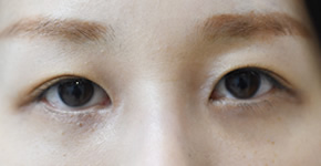「目の下のクマ取り（黒ずみ除去手術・皮膚切除）」の症例写真・ビフォーアフター