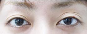 「三重まぶた改善治療（ヒアルロン酸＋眼瞼下垂手術）」の症例写真・ビフォーアフター