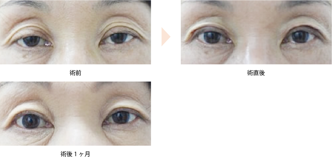 「腱膜性眼瞼下垂・挙筋腱膜短縮法（保険適用）」の症例写真・ビフォーアフター