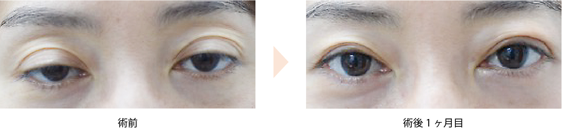 「眼瞼下垂術／腱膜前転法（後天性眼瞼下垂）」の症例写真・ビフォーアフター