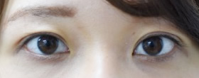 「二重切開術（眼瞼下垂手術をせずに目ヂカラをつける）」の症例写真・ビフォーアフター