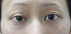 「上瞼くぼみ・ヒアルロン酸」の症例写真・ビフォーアフター