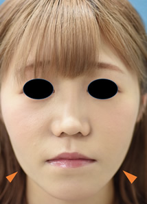 「小顔整形（頬脂肪吸引と鼻手術のコンビネーション）」の症例写真・ビフォーアフター