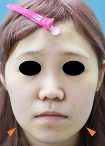 「小顔整形（頬脂肪吸引と鼻手術のコンビネーション）」の症例写真・ビフォーアフター