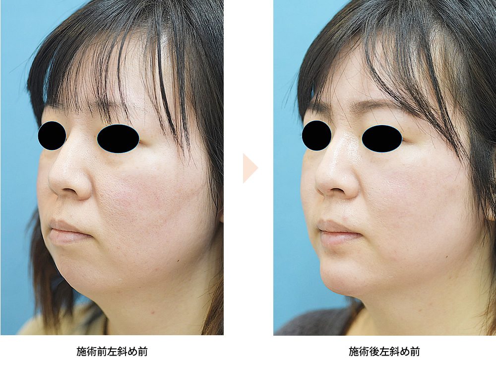「顎プロテーゼによる顎のライン調整・口ゴボ改善」の症例写真・ビフォーアフター