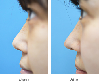 「鼻尖耳介軟骨移植（鼻先を高く／クローズド法）」の症例写真・ビフォーアフター