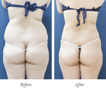 「ベイザー×アキーセル脂肪吸引（腰部・2部位）」の症例写真・ビフォーアフター