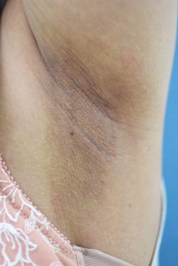 脇の黒ずみ治療 トーニング でより確実に結果を出す方法 池袋の美容皮膚科 美容外科なら みずほクリニック