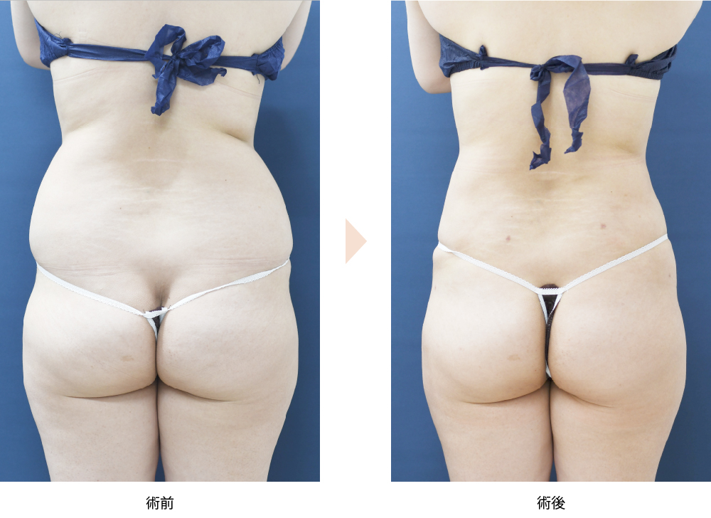 「ベイザー×アキーセル脂肪吸引（腰部）」の症例写真・ビフォーアフター