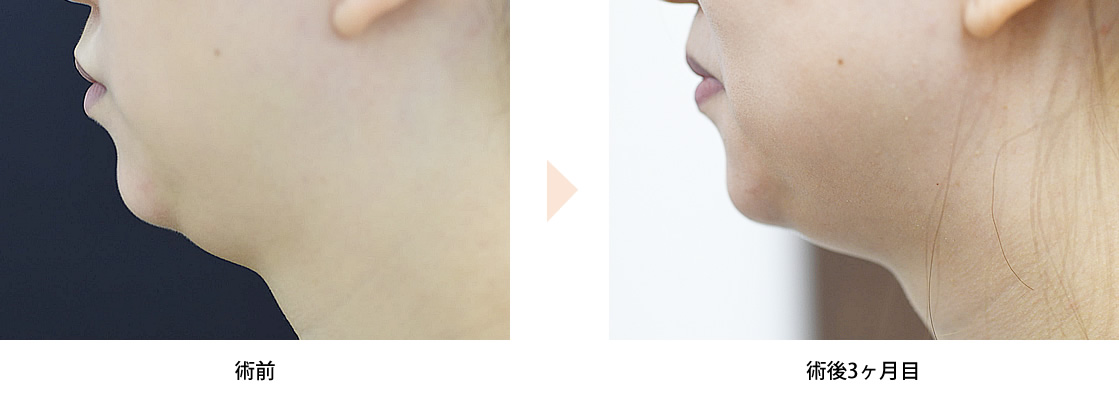 「顎下の脂肪除去（クルスカ・エリート）」の症例写真・ビフォーアフター