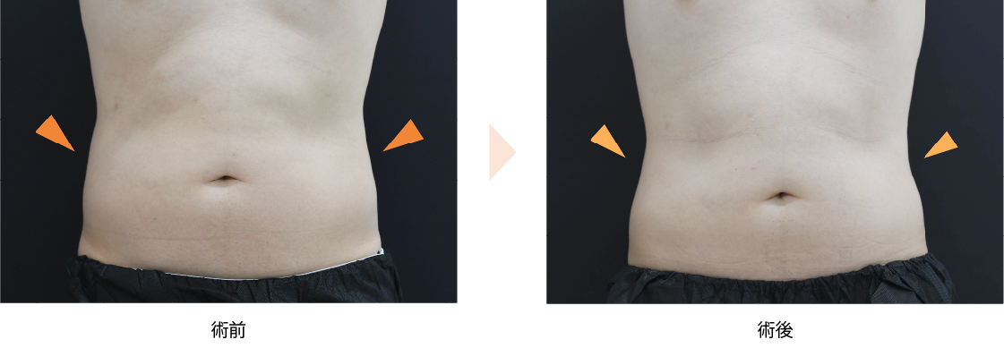 「腹部の痩身治療（クルスカ・エリート）」の症例写真・ビフォーアフター