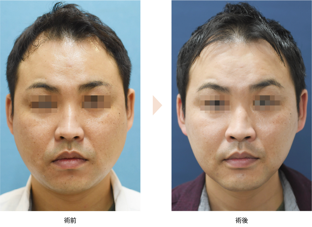 「頬・顎下の痩身治療（クルスカ・エリート）※当院オリジナル施術」の症例写真・ビフォーアフター
