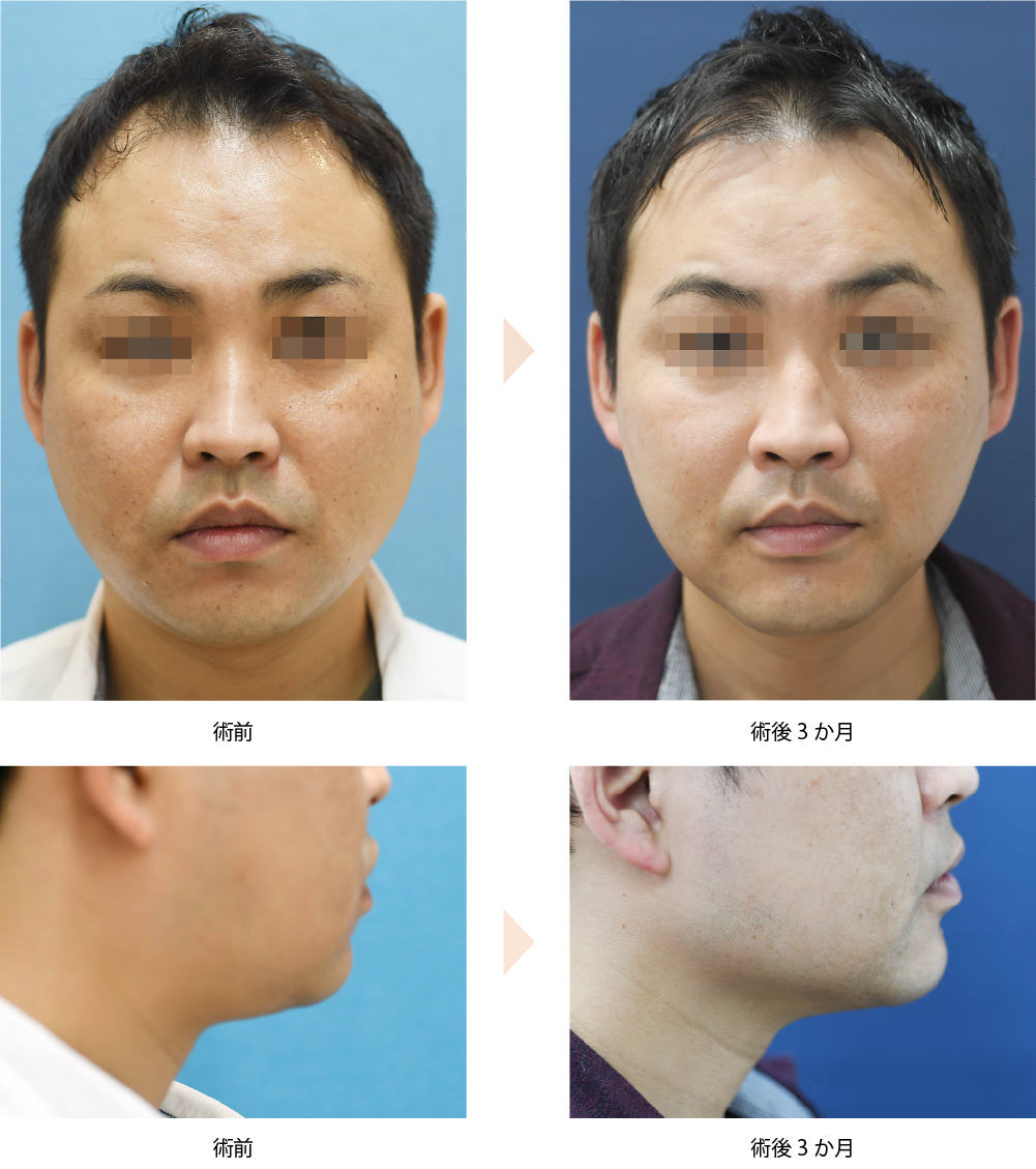 「頬・顎下の痩身治療（クルスカ・エリート）※当院オリジナル施術」の症例写真・ビフォーアフター