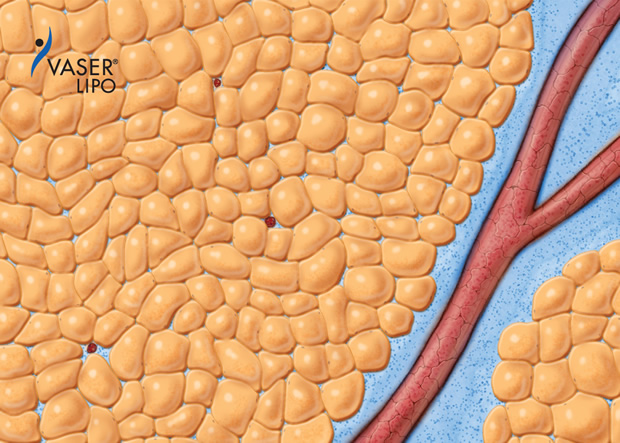 血管等の脈管と脂肪細胞の術前の状態。脂肪組織はタイトにパックされている。