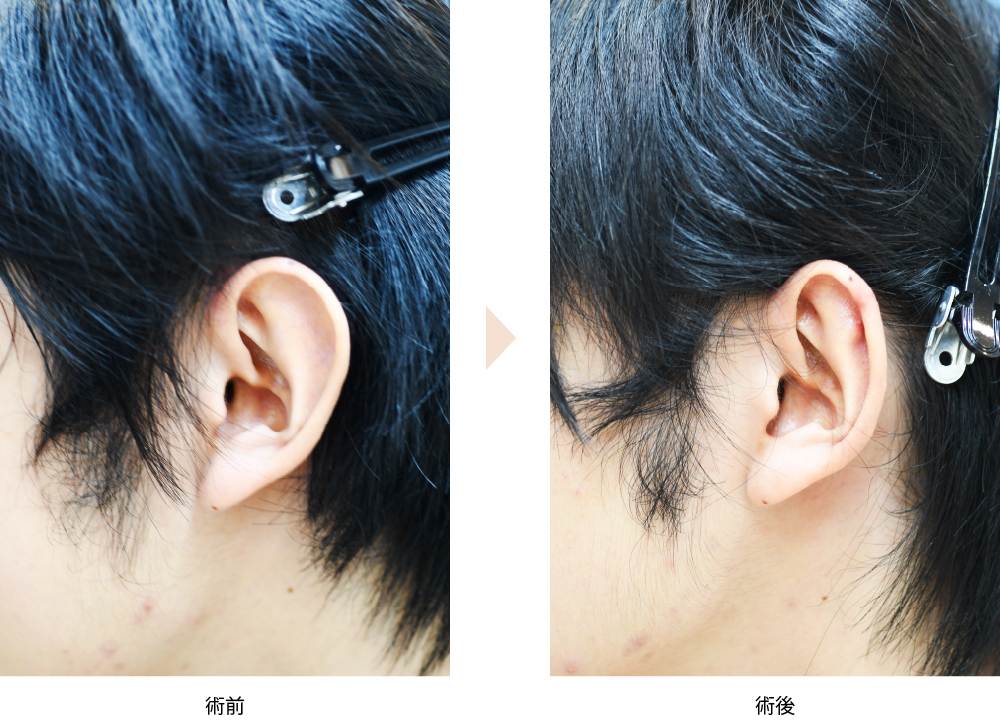 「耳縮小術（忘れ耳整形・耳輪舟状窩切除法）」の症例写真・ビフォーアフター
