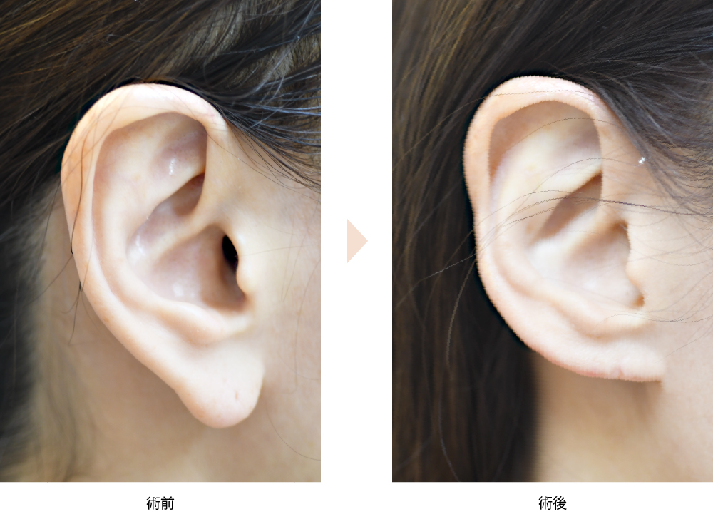 「耳垂縮小術（耳たぶを小さく見せる耳形成術）」の症例写真・ビフォーアフター
