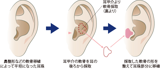 耳珠形成術の手術イメージ
