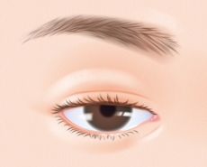 眼瞼下垂・筋膜移植術（保険診療・自由診療）