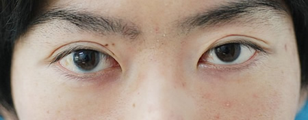 眼瞼下垂治療によって左右差を改善する