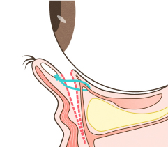 まぶた裏側からのアプローチ・CPF法／Capsulo-palpebral fascia（眼瞼筋膜）の短縮
