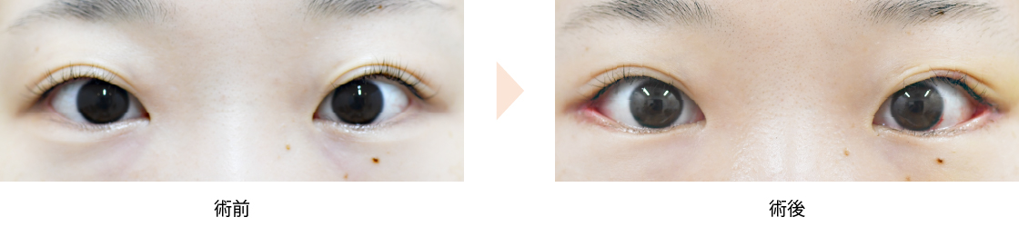 「グラマラスライン（タレ目）形成・目尻切開のコンビ治療」の症例写真・ビフォーアフター