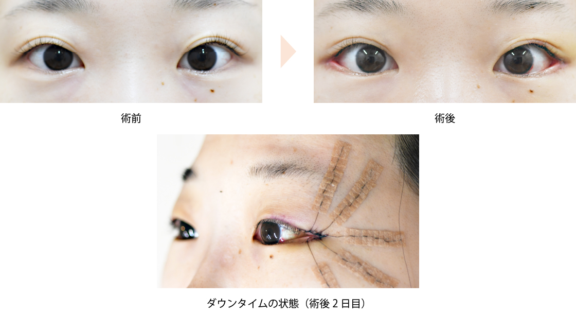 「グラマラスライン（タレ目）形成・目尻切開のコンビ治療」の症例写真・ビフォーアフター