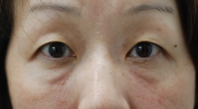 「目の下（下まぶた）のクマ・たるみ改善治療（ヒアルロン酸注入）」の症例写真・ビフォーアフター