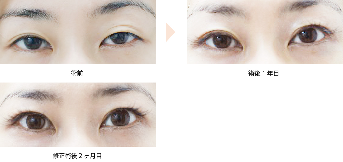 「眼瞼下垂手術後の二重ライン修正」の症例写真・ビフォーアフター