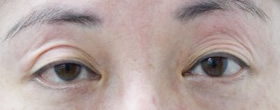 「三重まぶた改善治療（眼瞼下垂手術の応用）」の症例写真・ビフォーアフター