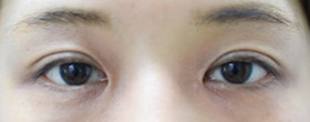 「三重まぶたと目の上のくぼみ治療（ヒアルロン酸＋二重埋没法）」の症例写真・ビフォーアフター