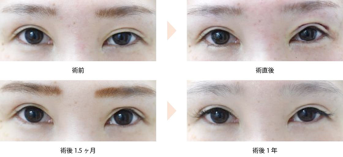 「眼瞼下垂治療（先天性＋医原性のケース）」の症例写真・ビフォーアフター