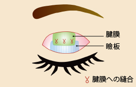 切開を伴う眼瞼下垂術（眼瞼挙筋前転法）