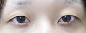 「二重切開術（眼瞼下垂手術をせずに目ヂカラをつける）」の症例写真・ビフォーアフター