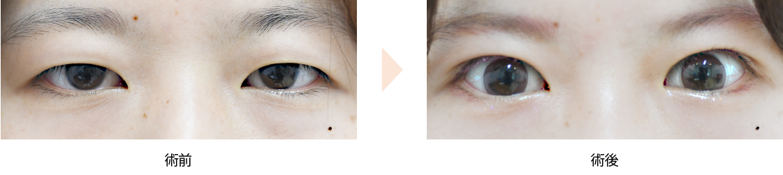 「目ヂカラアップに重点を置いた二重切開術（眼瞼下垂手術併用）」の症例写真・ビフォーアフター