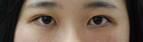 「上瞼・逆さまつげ（埋没法）」の症例写真・ビフォーアフター
