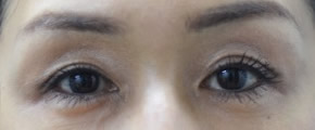 「上瞼くぼみ・ヒアルロン酸」の症例写真・ビフォーアフター