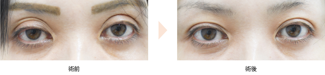 「上まぶたのくぼみ・三重まぶた・眼瞼下垂治療（ヒアルロン酸注入）」の症例写真・ビフォーアフター