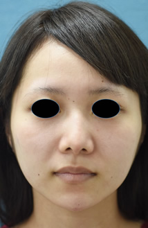 「複合技による小顔治療・シャープな雰囲気に変える」の症例写真・ビフォーアフター