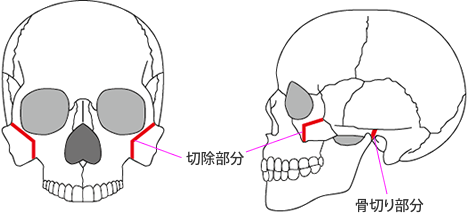 頬骨体部の骨削り＋頬骨弓部の骨切りのイメージ