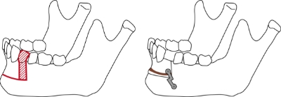 下顎前歯部歯槽骨切り術（下顎セットバック整形）の詳細