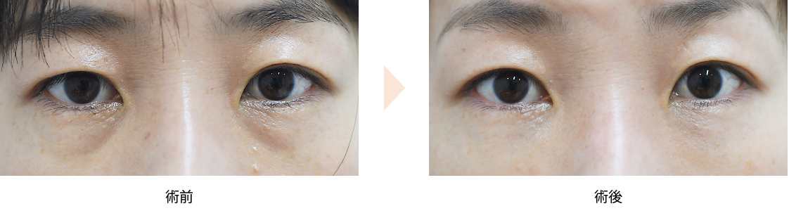 「目の下（下まぶた）クマ改善治療（ヒアルロン酸注入）」の症例写真・ビフォーアフター