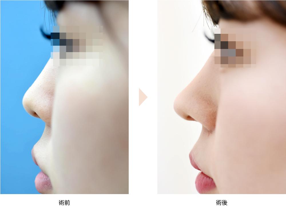 「鼻中隔延長術（単独手術）」の症例写真・ビフォーアフター