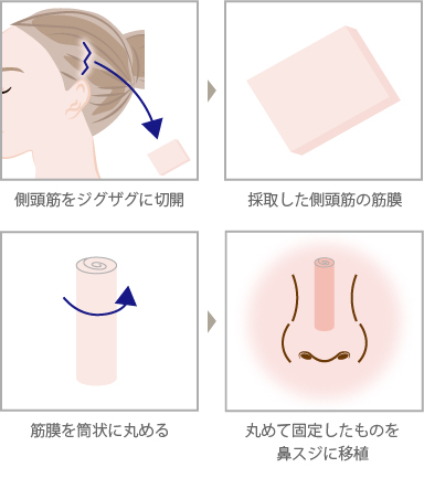 自家組織による隆鼻術の種類