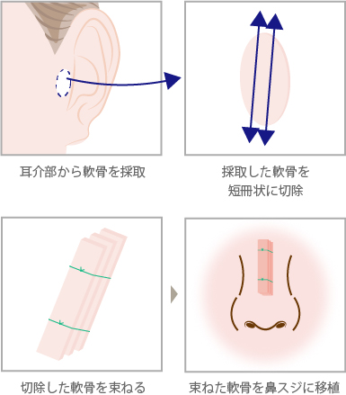 耳介軟骨移植