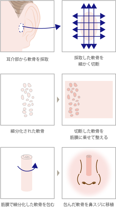 側頭筋膜＋耳介軟骨（細切片）