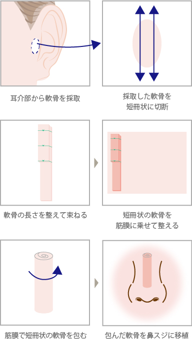 側頭筋膜＋耳介軟骨（耳介軟骨短冊片）